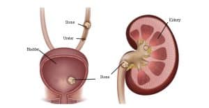 علائم سنگ کلیه چیست؟ و چگونه درمان می‌شود؟